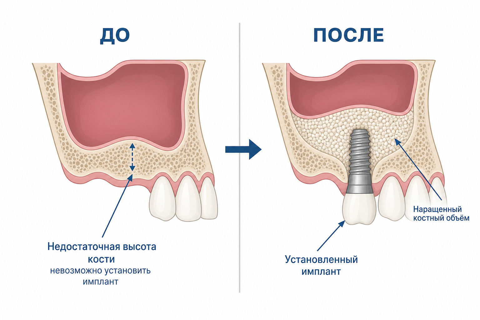 принцип синус лифтинга, схема наглядно